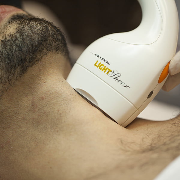Depilação à laser de faixa de barba